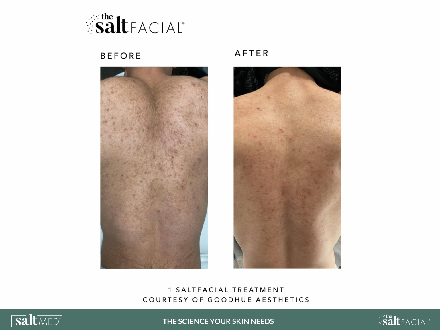 Salt Facial Before & After 3